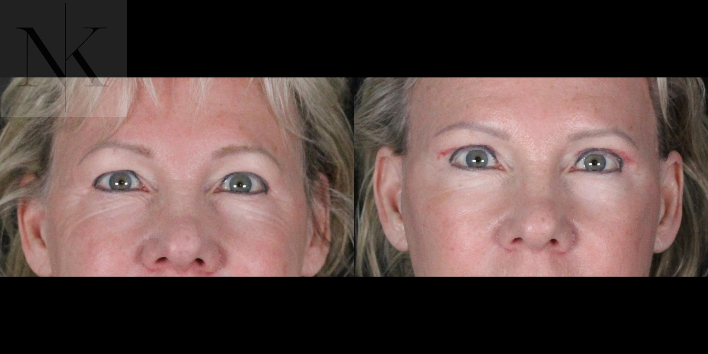Before & After Brow Lift Case 164 Front View in Wethersfield, Hartford, Nebraska