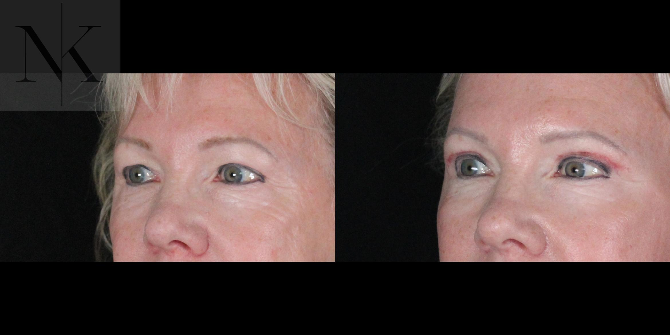 Before & After Brow Lift Case 164 Left Oblique View in Wethersfield, Hartford, Nebraska