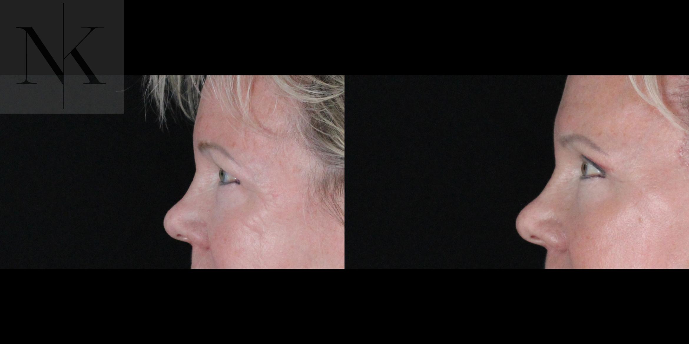 Before & After Brow Lift Case 164 Left Side View in Wethersfield, Hartford, Nebraska
