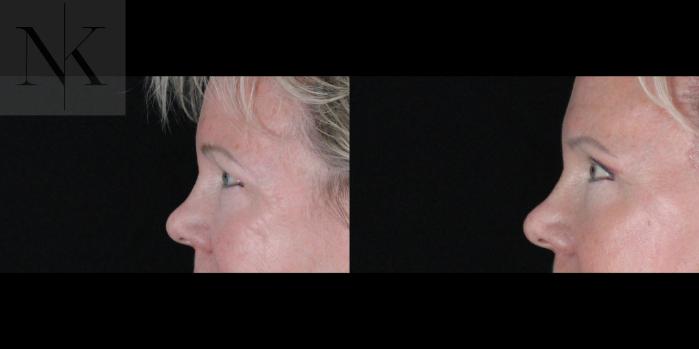 Before & After Brow Lift Case 164 Left Side View in Wethersfield, Hartford, Nebraska
