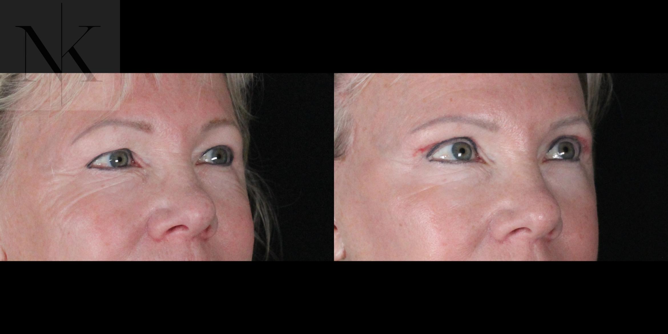 Before & After Brow Lift Case 164 Right Oblique View in Wethersfield, Hartford, Nebraska