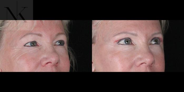 Before & After Brow Lift Case 164 Right Oblique View in Wethersfield, Hartford, Nebraska