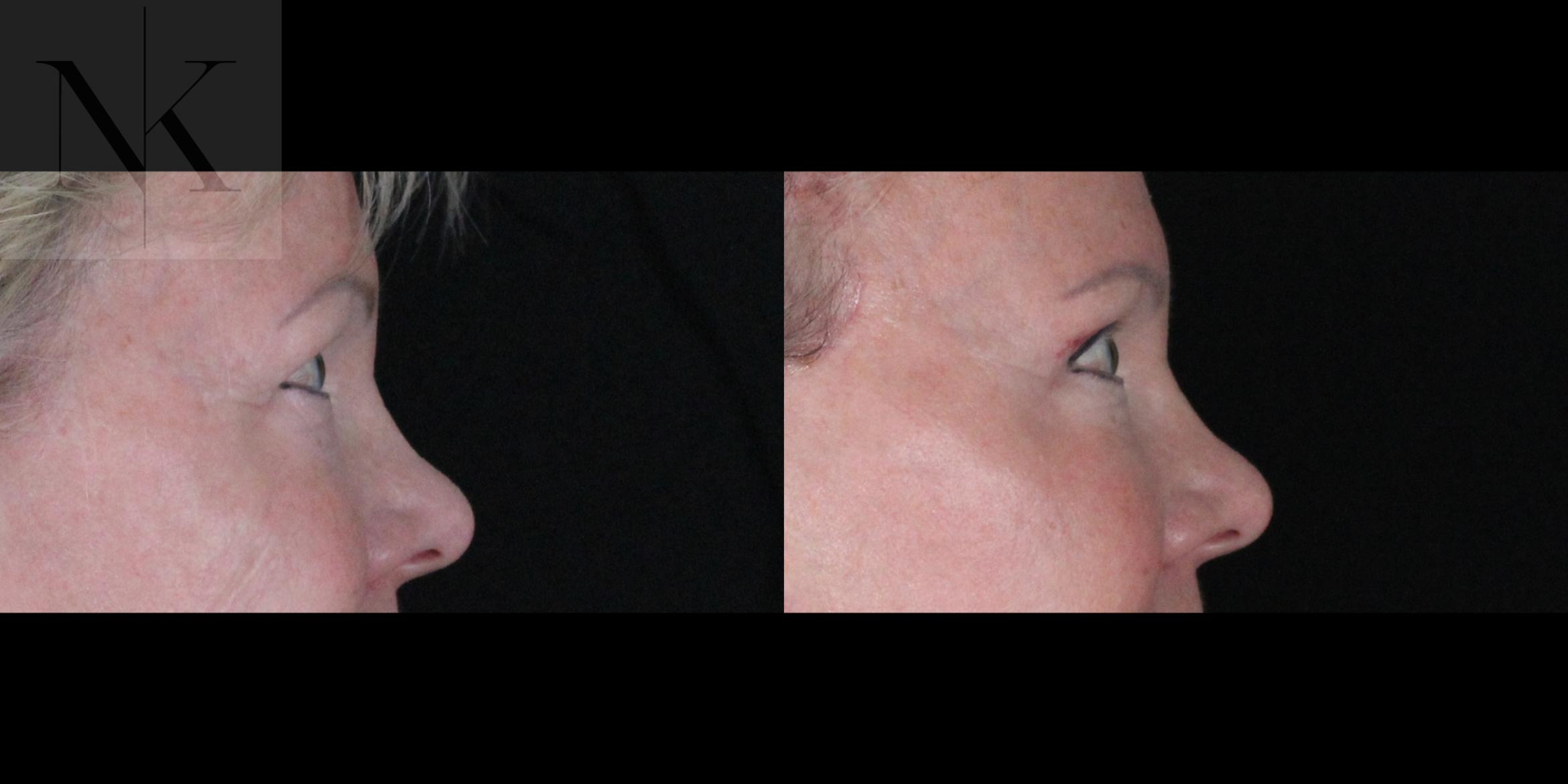Before & After Brow Lift Case 164 Right Side View in Wethersfield, Hartford, Nebraska