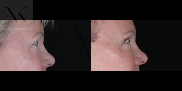 Before & After Brow Lift Case 164 Right Side View in Wethersfield, Hartford, Nebraska