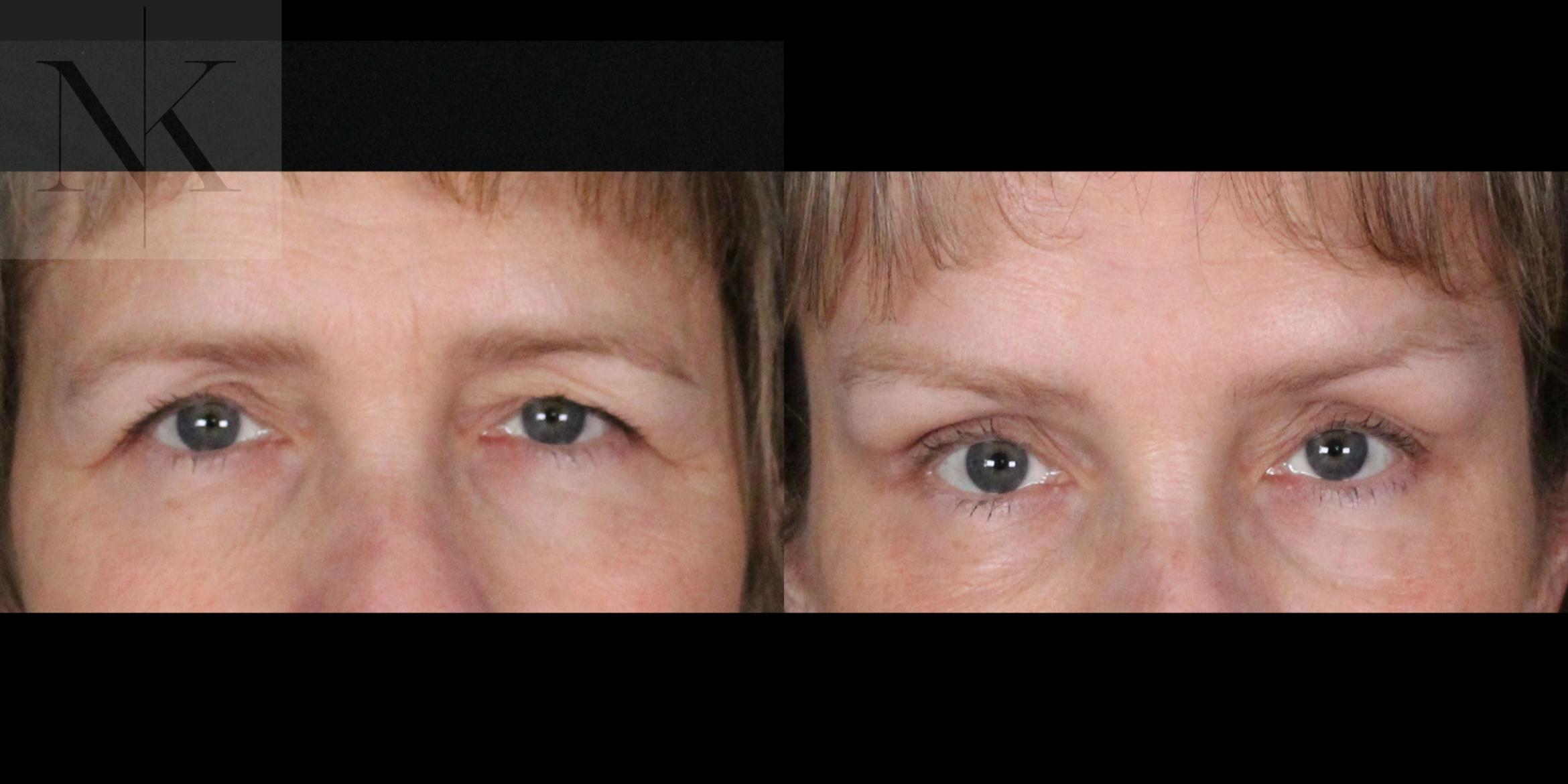 Before & After Brow Lift Case 165 Front View in Wethersfield, Hartford, Nebraska
