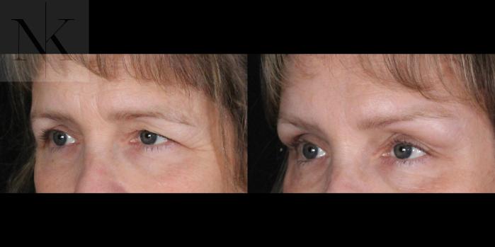 Before & After Brow Lift Case 165 Left Oblique View in Wethersfield, Hartford, Nebraska