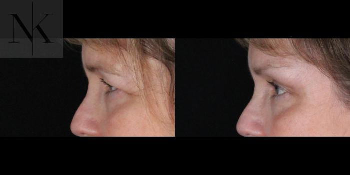 Before & After Brow Lift Case 165 Left Side View in Wethersfield, Hartford, Nebraska