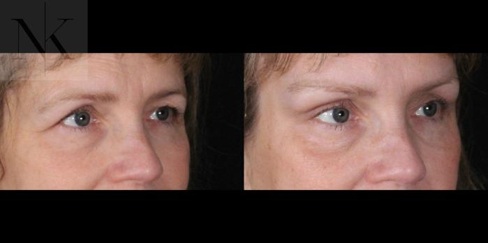 Before & After Brow Lift Case 165 Right Oblique View in Wethersfield, Hartford, Nebraska