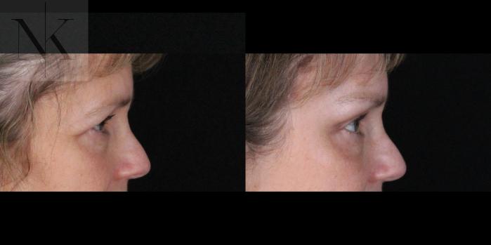 Before & After Brow Lift Case 165 Right Side View in Wethersfield, Hartford, Nebraska