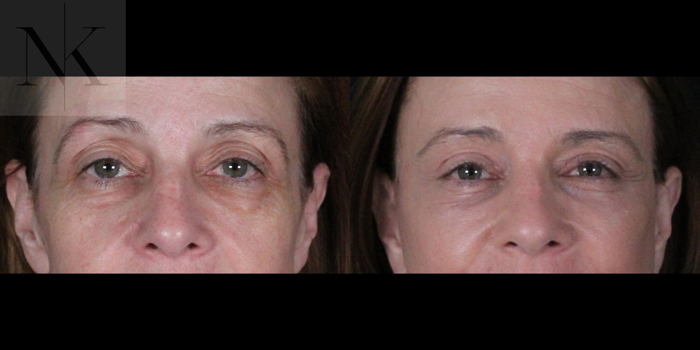Before & After Brow Lift Case 166 Front View in Wethersfield, Hartford, Nebraska
