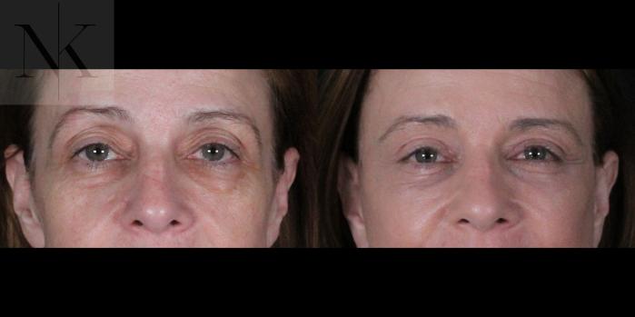 Before & After Brow Lift Case 166 Front View in Wethersfield, Hartford, Nebraska