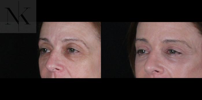 Before & After Brow Lift Case 166 Left Oblique View in Wethersfield, Hartford, Nebraska