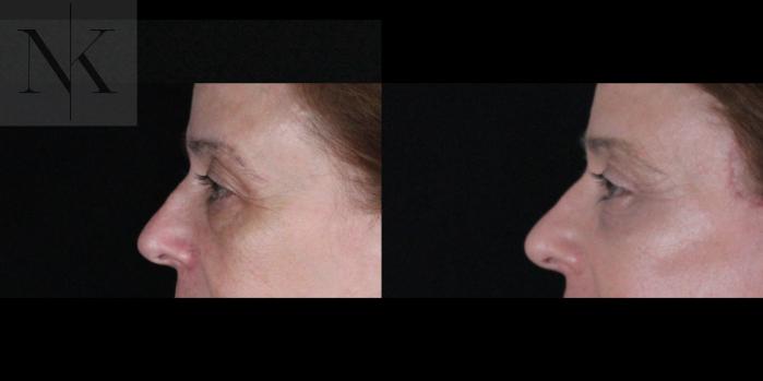 Before & After Brow Lift Case 166 Left Side View in Wethersfield, Hartford, Nebraska