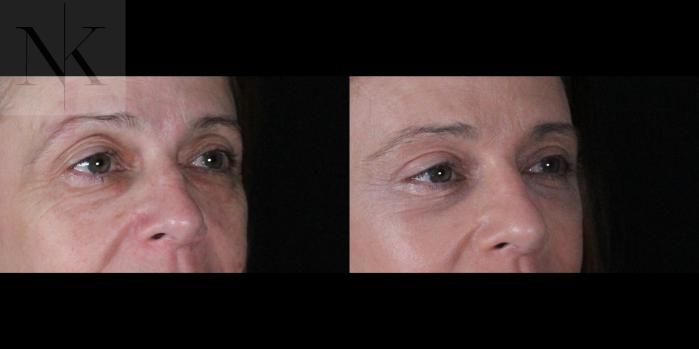 Before & After Brow Lift Case 166 Right Oblique View in Wethersfield, Hartford, Nebraska