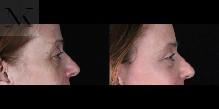 Before & After Brow Lift Case 166 Right Side View in Wethersfield, Hartford, Nebraska