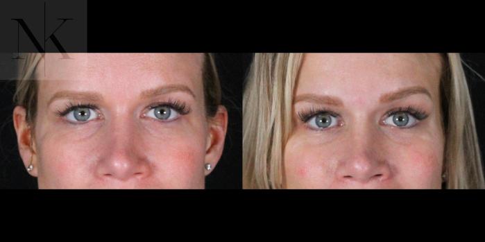 Before & After Brow Lift Case 169 Front View in Wethersfield, Hartford, Nebraska