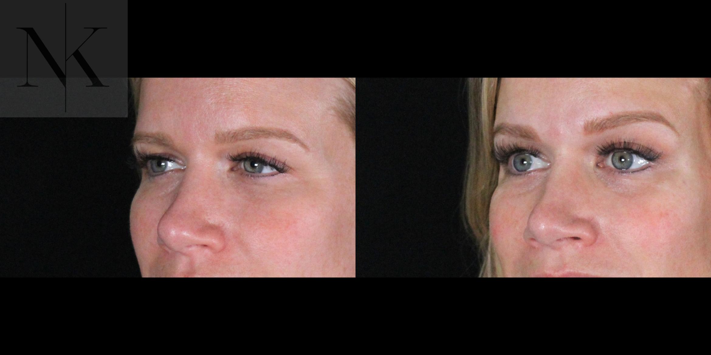 Before & After Brow Lift Case 169 Left Oblique View in Wethersfield, Hartford, Nebraska