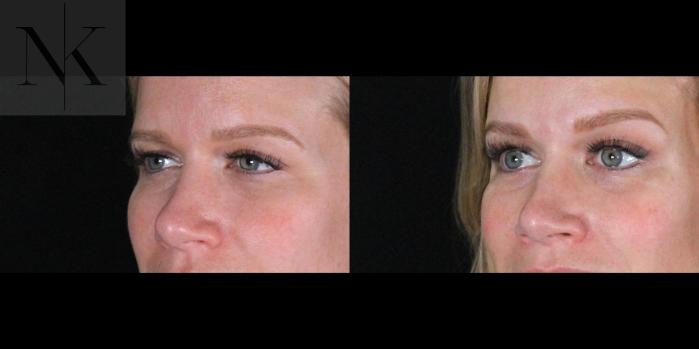Before & After Brow Lift Case 169 Left Oblique View in Wethersfield, Hartford, Nebraska