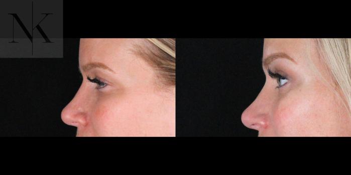 Before & After Brow Lift Case 169 Left Side View in Wethersfield, Hartford, Nebraska