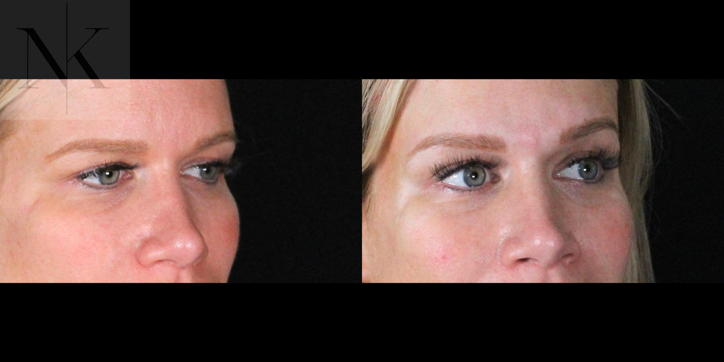 Before & After Brow Lift Case 169 Right Oblique View in Wethersfield, Hartford, Nebraska