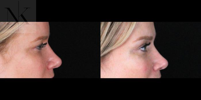 Before & After Brow Lift Case 169 Right Side View in Wethersfield, Hartford, Nebraska
