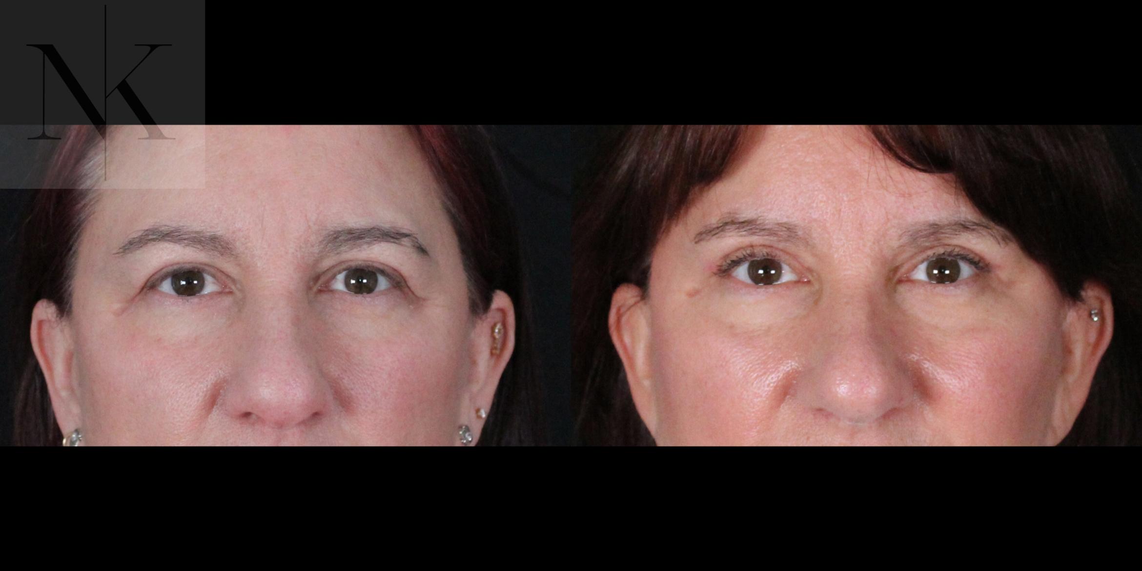 Before & After Brow Lift Case 170 Front View in Wethersfield, Hartford, Nebraska