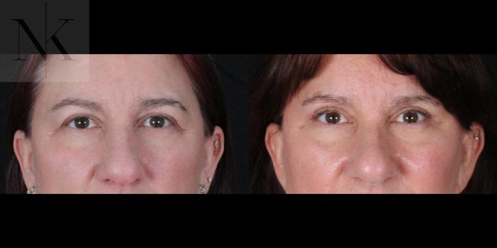 Before & After Brow Lift Case 170 Front View in Wethersfield, Hartford, Nebraska