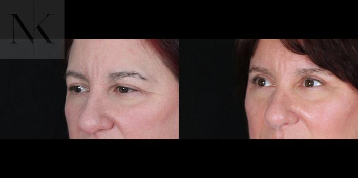 Before & After Brow Lift Case 170 Left Oblique View in Wethersfield, Hartford, Nebraska