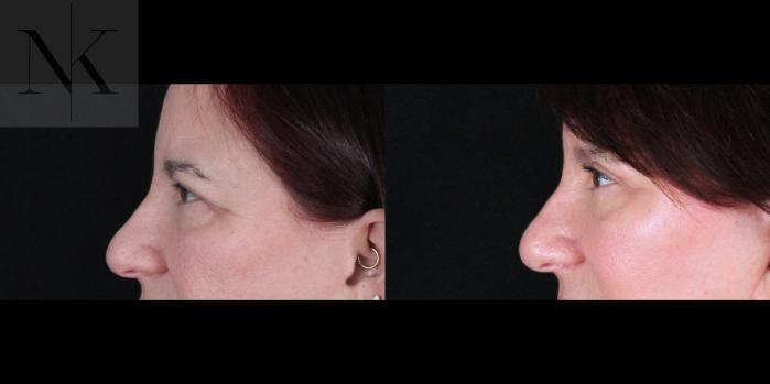 Before & After Brow Lift Case 170 Left Side View in Wethersfield, Hartford, Nebraska