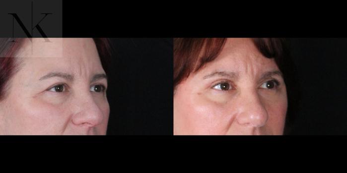 Before & After Brow Lift Case 170 Right Oblique View in Wethersfield, Hartford, Nebraska