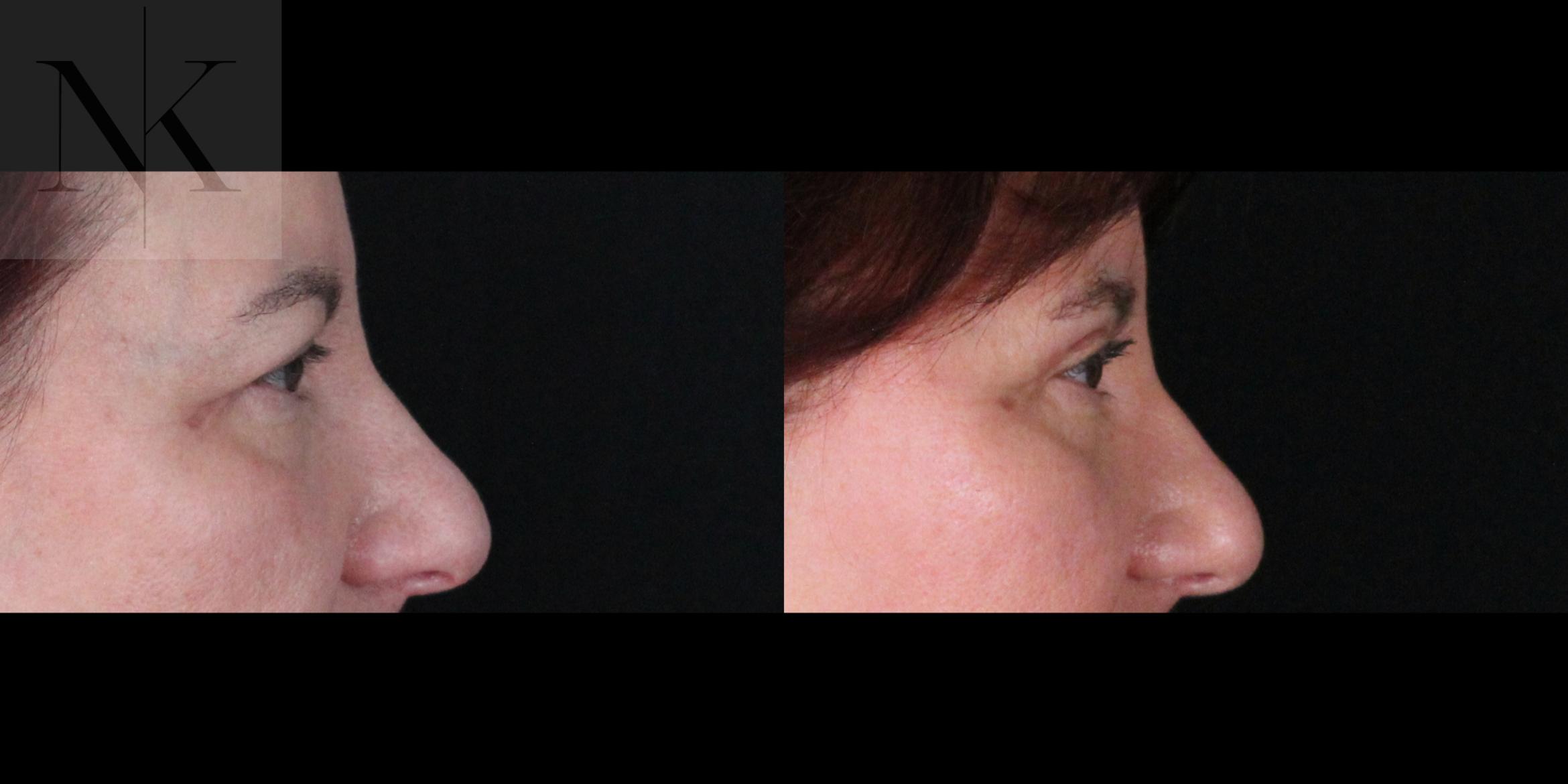 Before & After Brow Lift Case 170 Right Side View in Wethersfield, Hartford, Nebraska