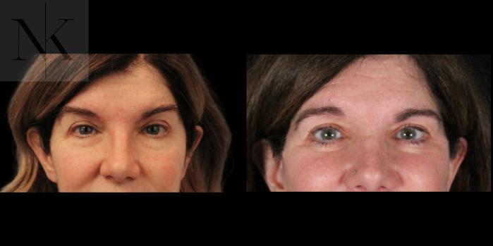 Before & After Brow Lift Case 172 Front View in Wethersfield, Hartford, Nebraska