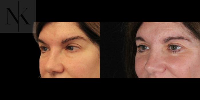 Before & After Brow Lift Case 172 Left Oblique View in Wethersfield, Hartford, Nebraska