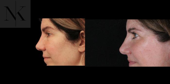 Before & After Brow Lift Case 172 Left Side View in Wethersfield, Hartford, Nebraska