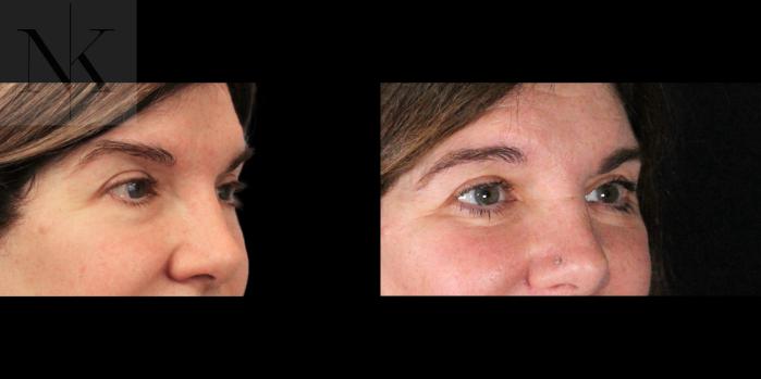 Before & After Brow Lift Case 172 Right Oblique View in Wethersfield, Hartford, Nebraska