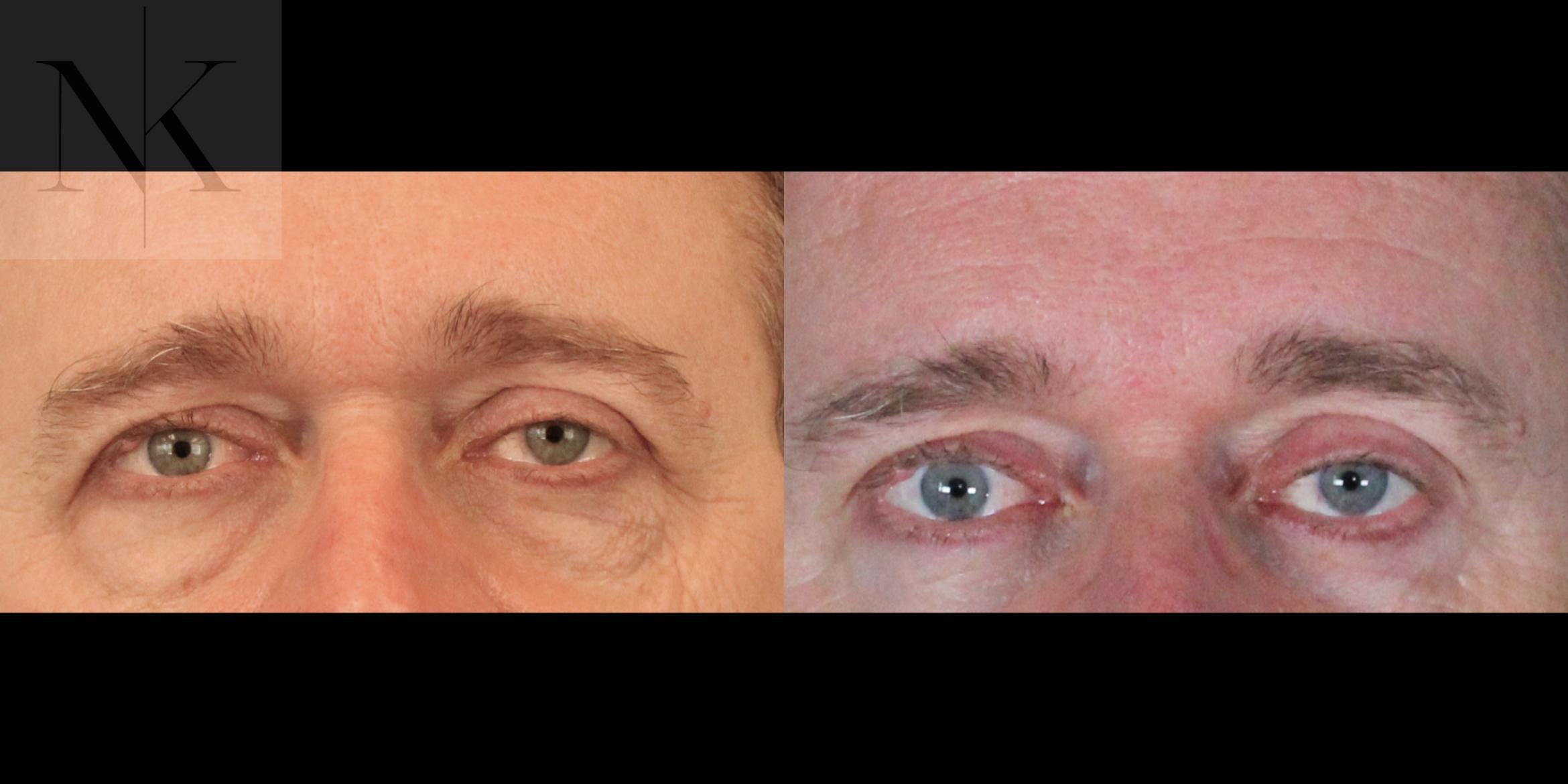 Before & After Brow Lift Case 202 Front View in Wethersfield, Hartford, Nebraska