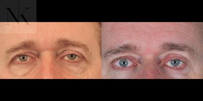 Before & After Brow Lift Case 202 Front View in Wethersfield, Hartford, Nebraska