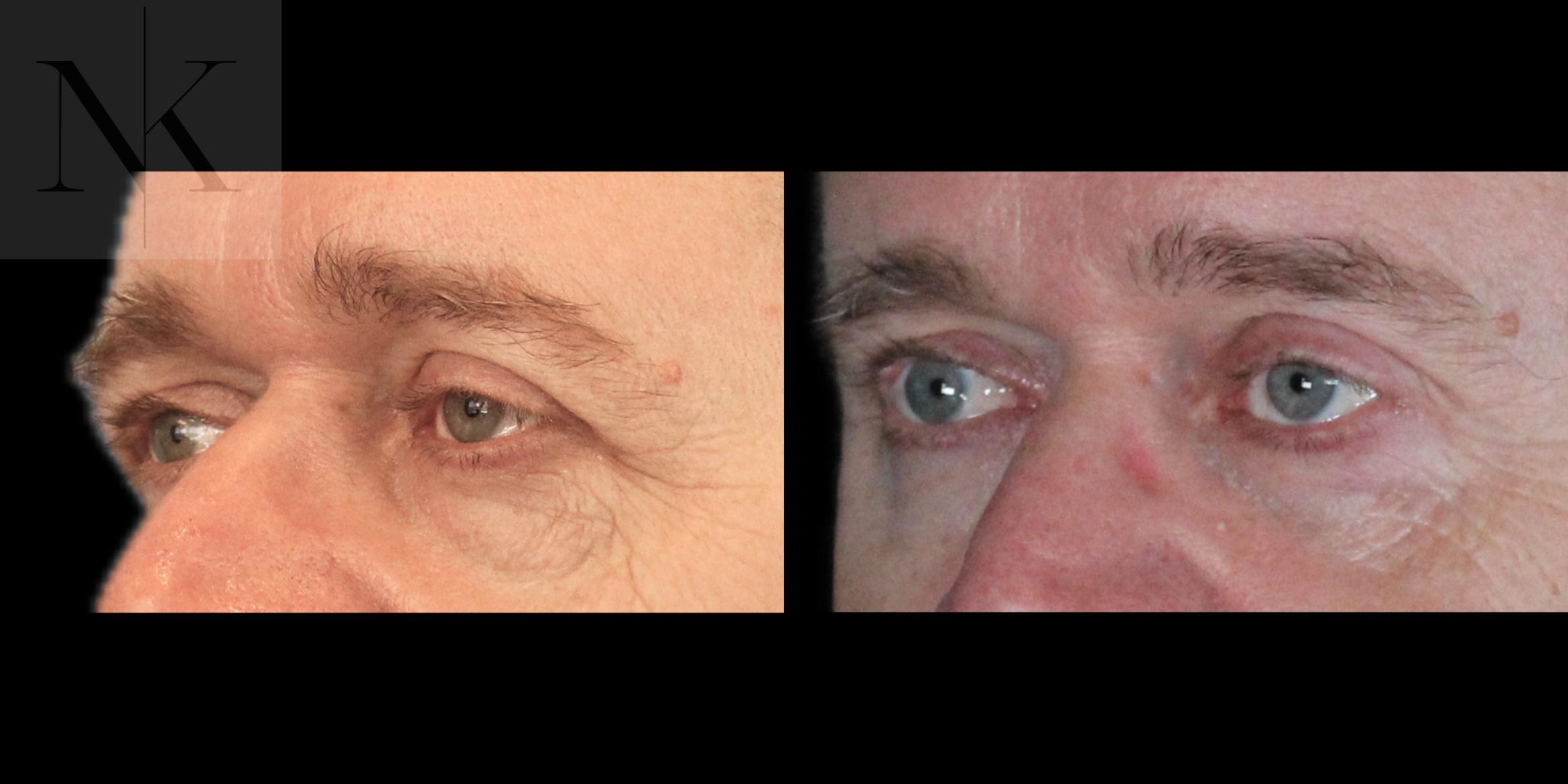 Before & After Brow Lift Case 202 Left Oblique View in Wethersfield, Hartford, Nebraska