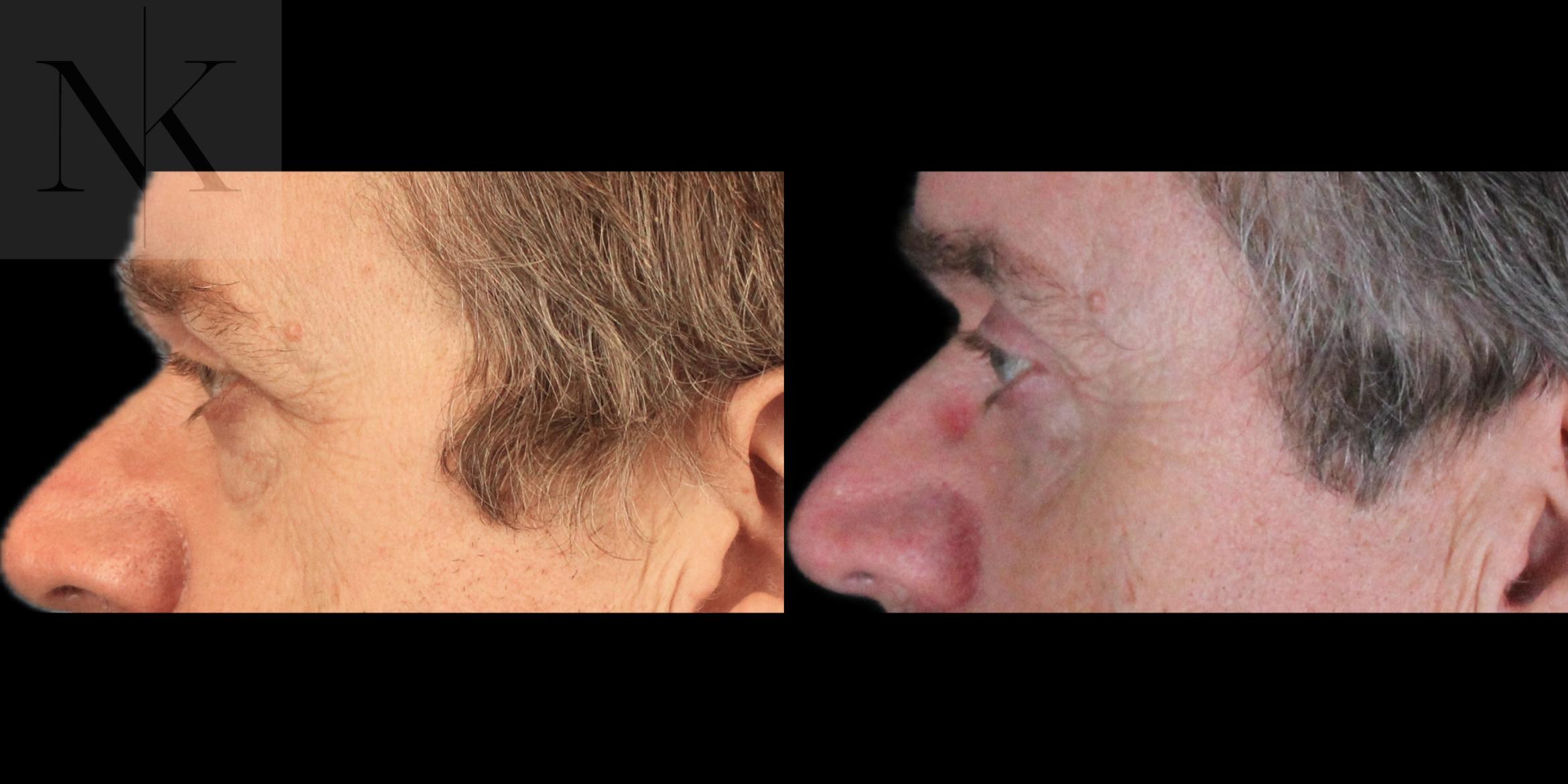 Before & After Brow Lift Case 202 Left Side View in Wethersfield, Hartford, Nebraska
