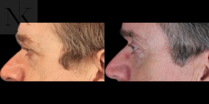 Before & After Brow Lift Case 202 Left Side View in Wethersfield, Hartford, Nebraska