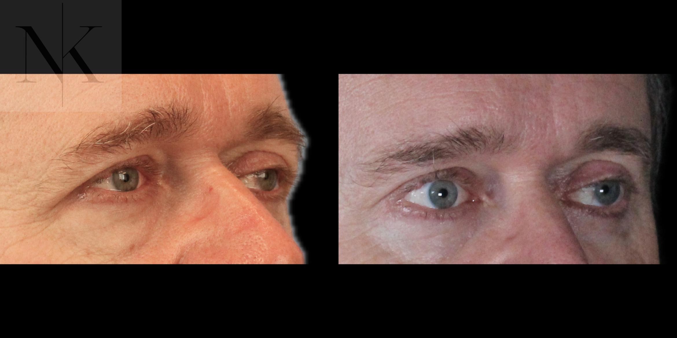 Before & After Brow Lift Case 202 Right Oblique View in Wethersfield, Hartford, Nebraska