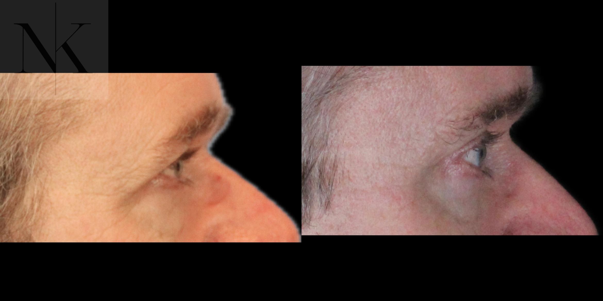Before & After Brow Lift Case 202 Right Side View in Wethersfield, Hartford, Nebraska