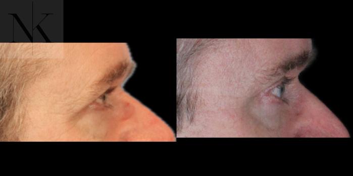 Before & After Brow Lift Case 202 Right Side View in Wethersfield, Hartford, Nebraska