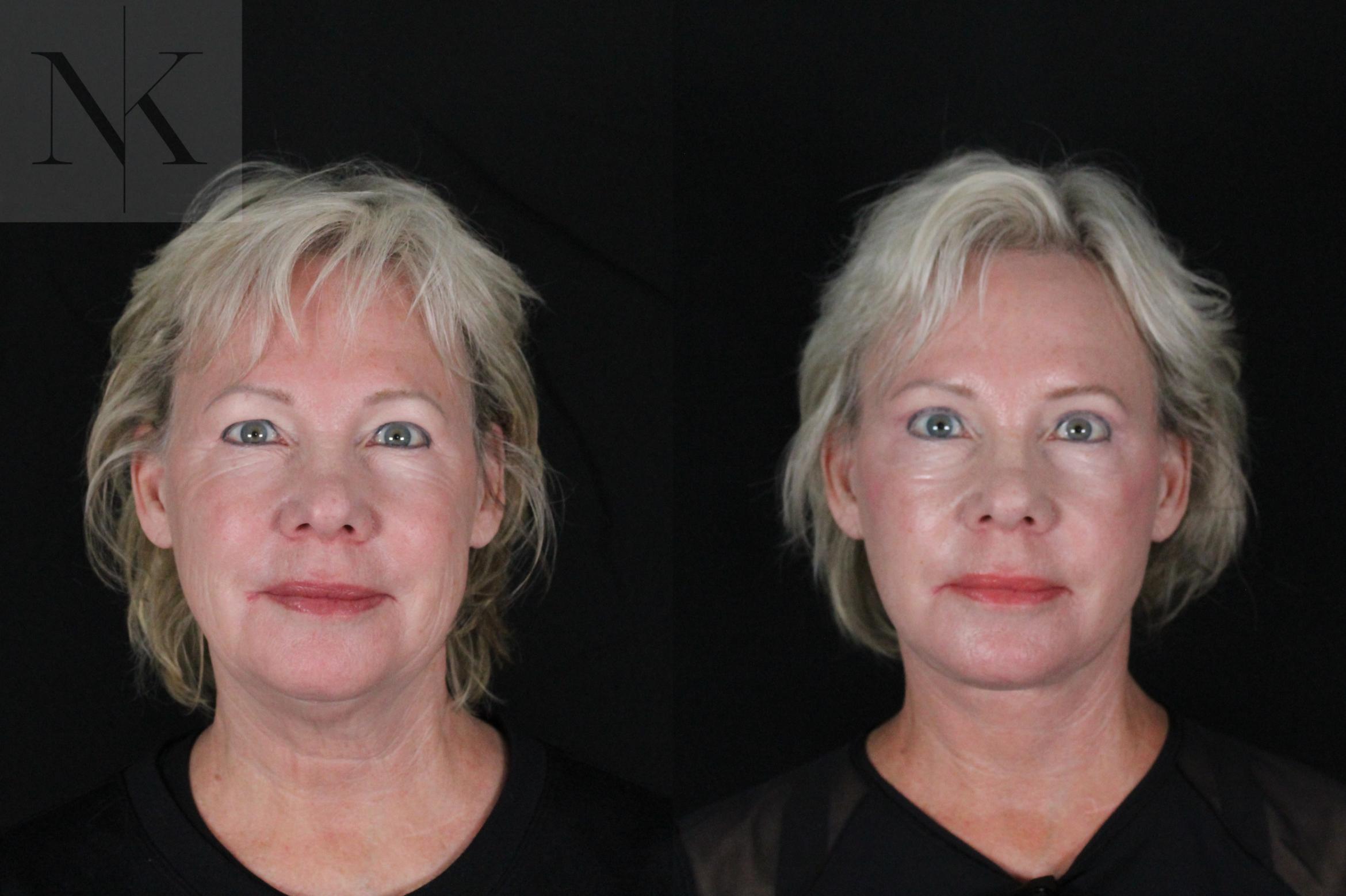 Before & After Deep Plane Facelift Case 167 Front View in Wethersfield, Hartford, Nebraska