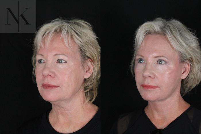 Before & After Deep Plane Facelift Case 167 Left Oblique View in Wethersfield, Hartford, Nebraska