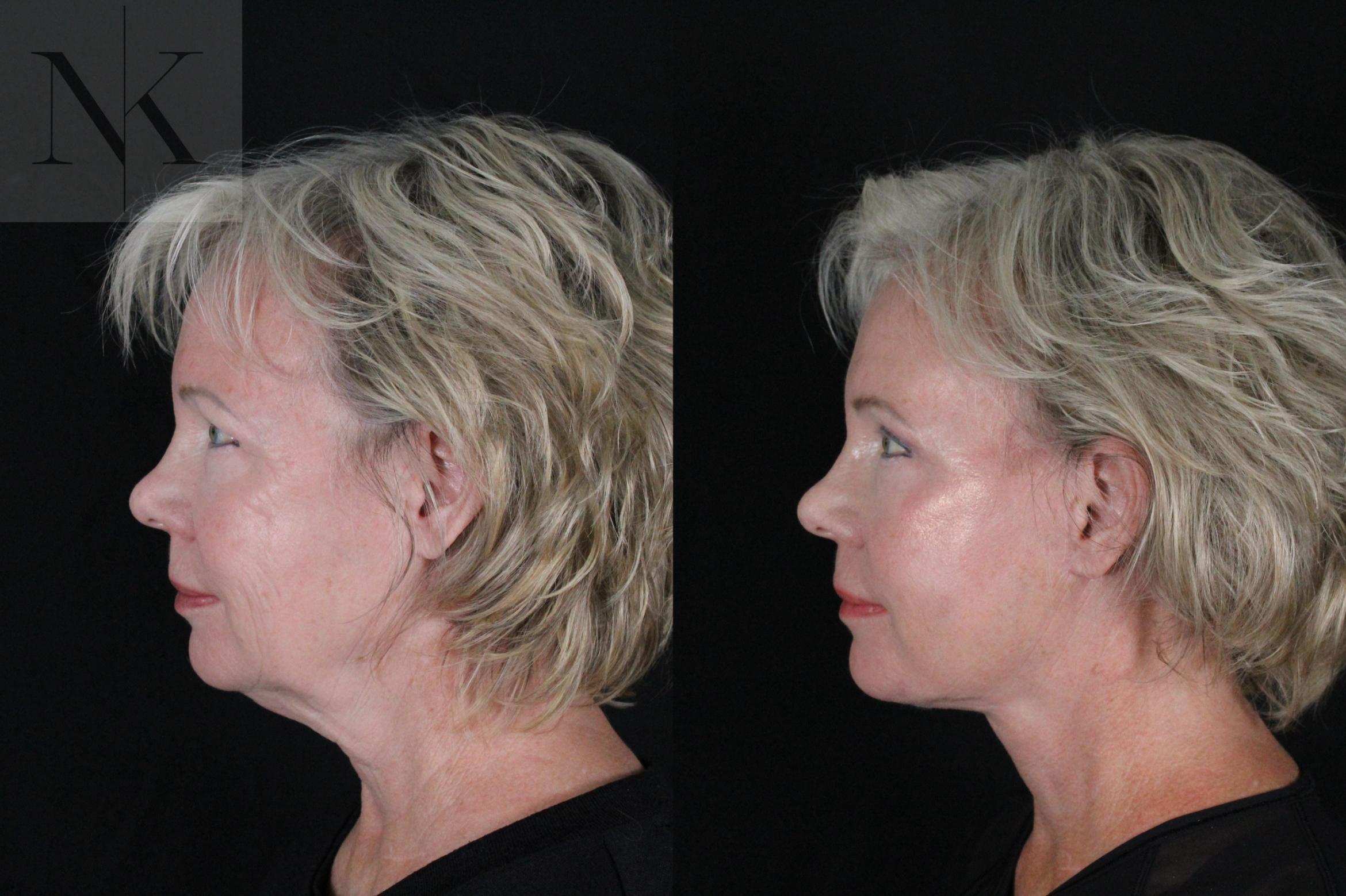 Before & After Deep Plane Facelift Case 167 Left Side View in Wethersfield, Hartford, Nebraska