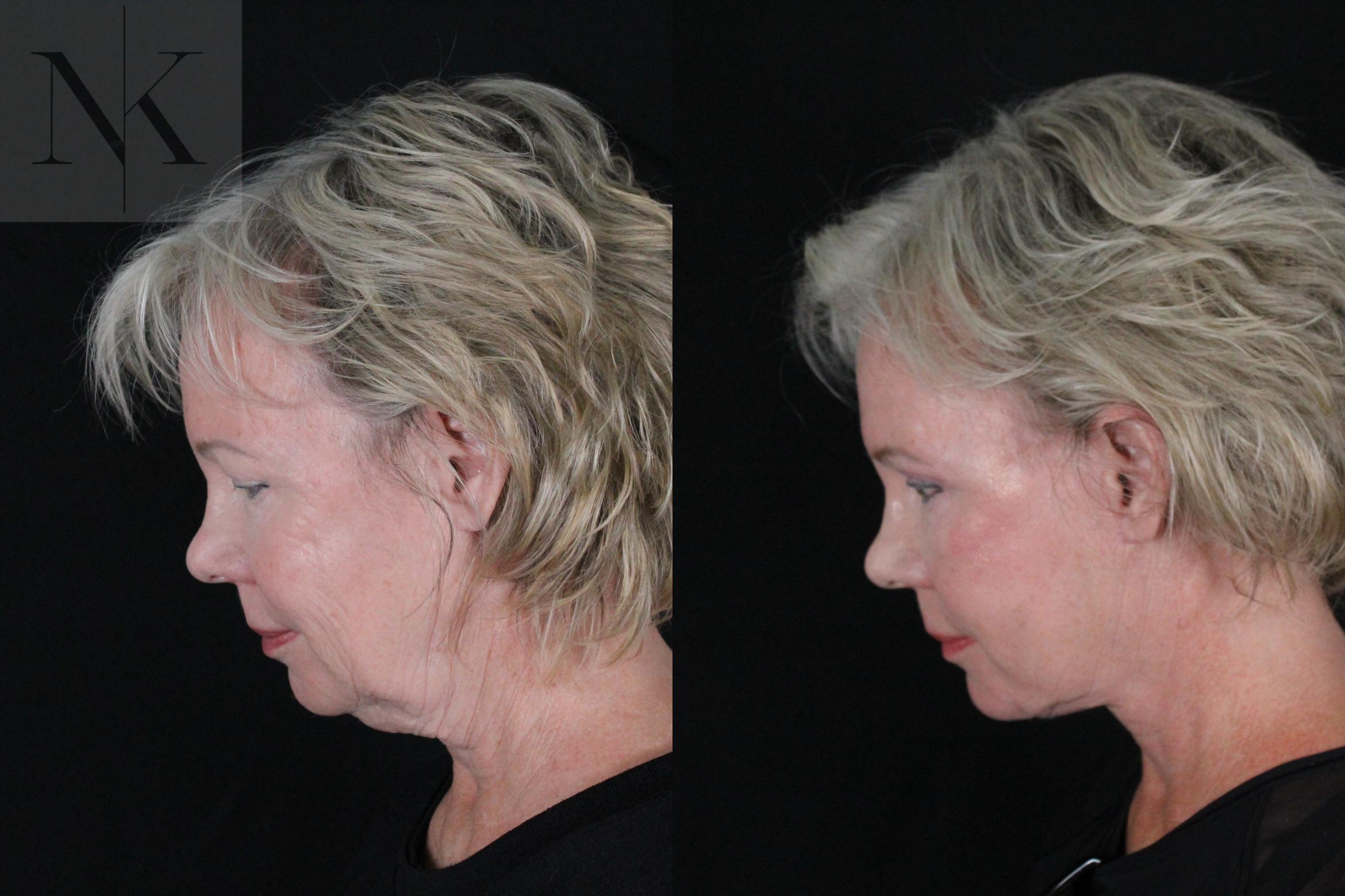 Before & After Deep Plane Facelift Case 167 Left Side Down View in Wethersfield, Hartford, Nebraska