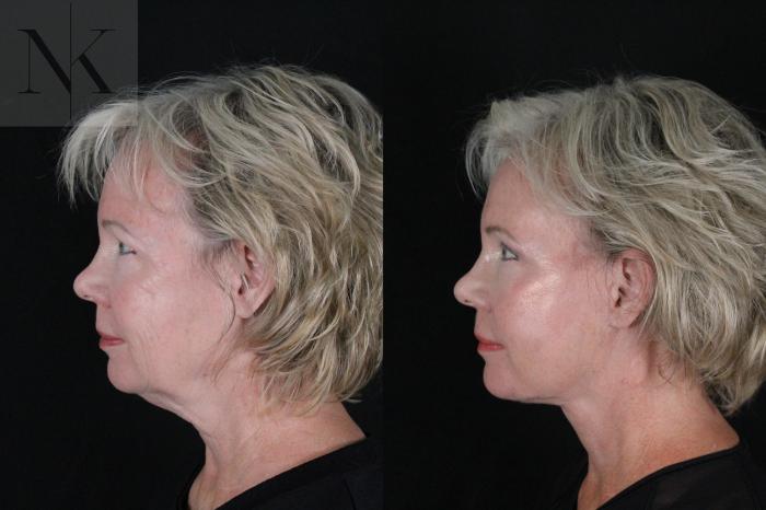 Before & After Deep Plane Facelift Case 167 Left Side View in Wethersfield, Hartford, Nebraska
