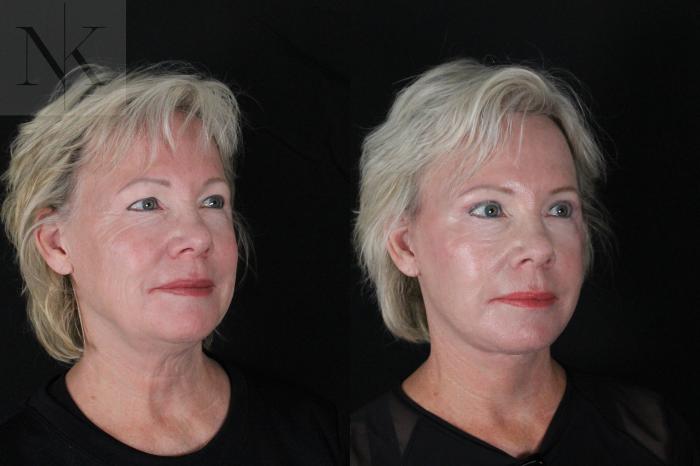 Before & After Deep Plane Facelift Case 167 Right Oblique View in Wethersfield, Hartford, Nebraska