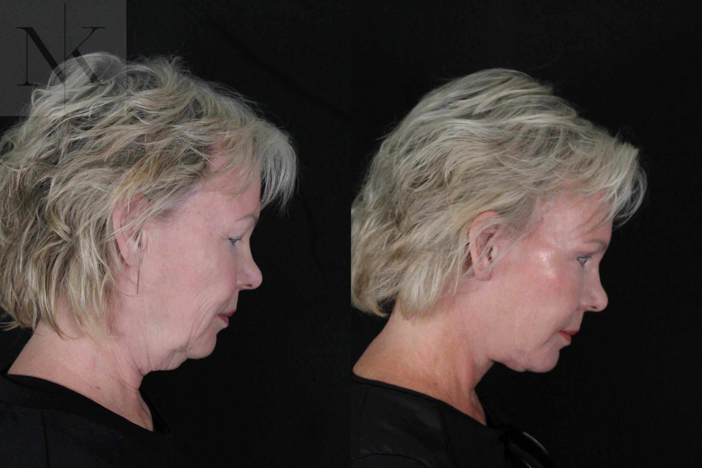 Before & After Deep Plane Facelift Case 167 Right Side Down View in Wethersfield, Hartford, Nebraska